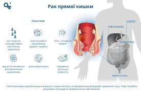 РАК ПРЯМОЇ КИШКИ